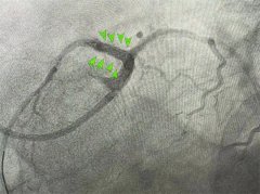 同济大学附属东方医院胶州医院:多学科联合救治，众志成城再创奇迹