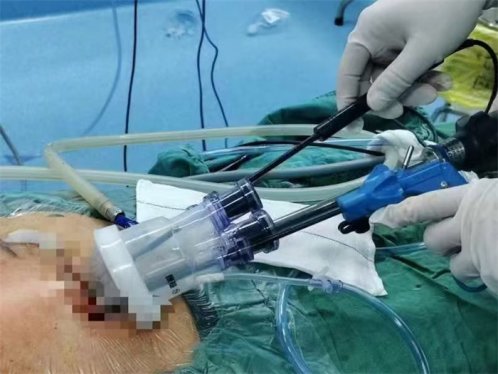 治“疝”至美|同济大学附属东方医院胶州医院成功实施腹腔镜下单孔切口疝修补术